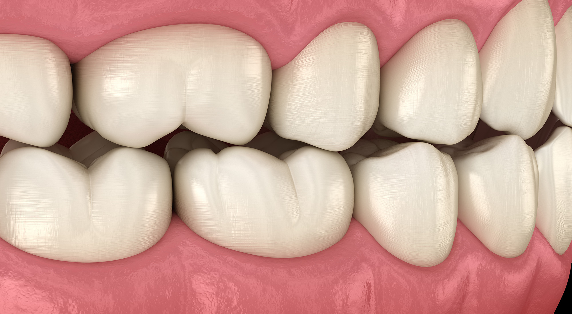 Occlusal Adjustment Campus Commons Periodontics Sacramento, CA