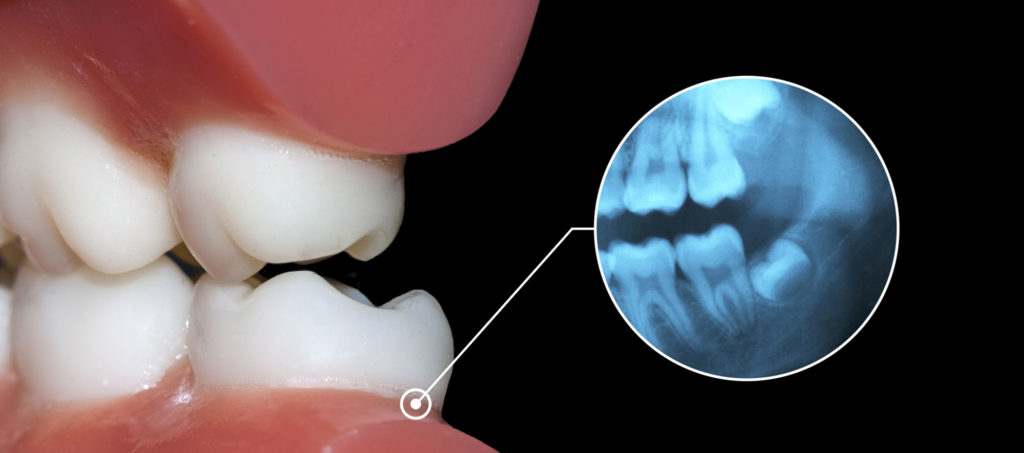 Occlusal Adjustment Campus Commons Periodontics Sacramento, CA