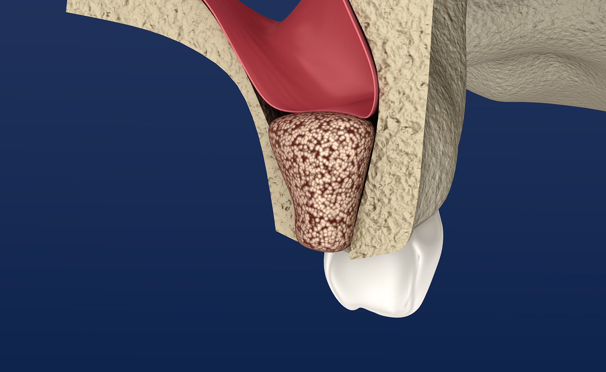 Sinus Lift Campus Commons Periodontics Sacramento, CA