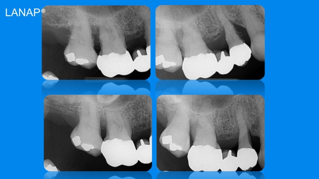 Before and after Campus Commons Periodontics Sacramento, CA