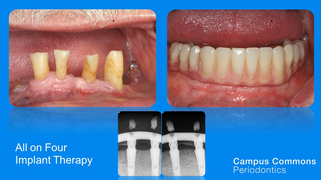 Before and after Campus Commons Periodontics Sacramento, CA