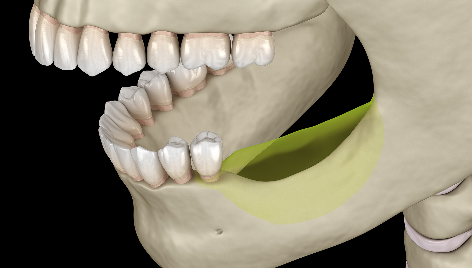 Tooth and bone loss Campus Commons Periodontics Sacramento, CA